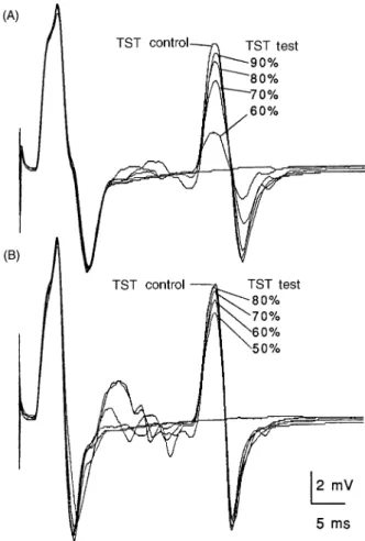 Fig. 4 Recordings using the TST. Responses from the ADM using different stimulus intensities and facilitation manoeuvres (Subject 15)