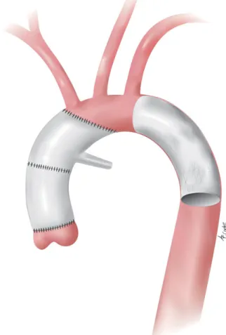 Figure 2: Hemiarch replacement with antegrade TEVAR. TEVAR: thoracic endo- endo-vascular aortic repair.