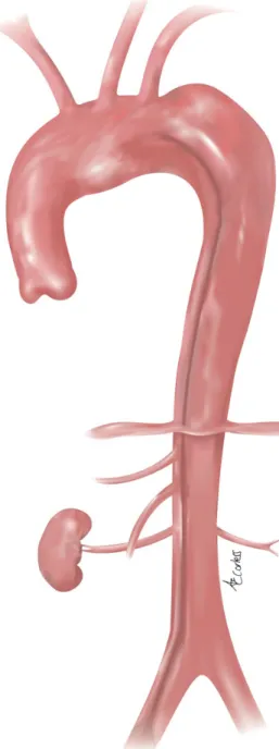 Figure 5: Scenario after ascending/hemiarch replacement with aneurysm for- for-mation due to a persistently patent primary entry tear in the distal aortic arch amendable to the FET technique.
