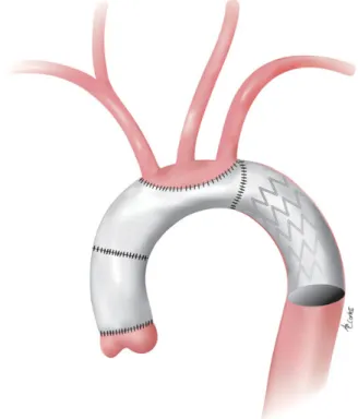 Figure 9: Scheme of FET implantation with the Vascutek device using a sepa- sepa-rated reimplantation of the supra-aortic vessels.