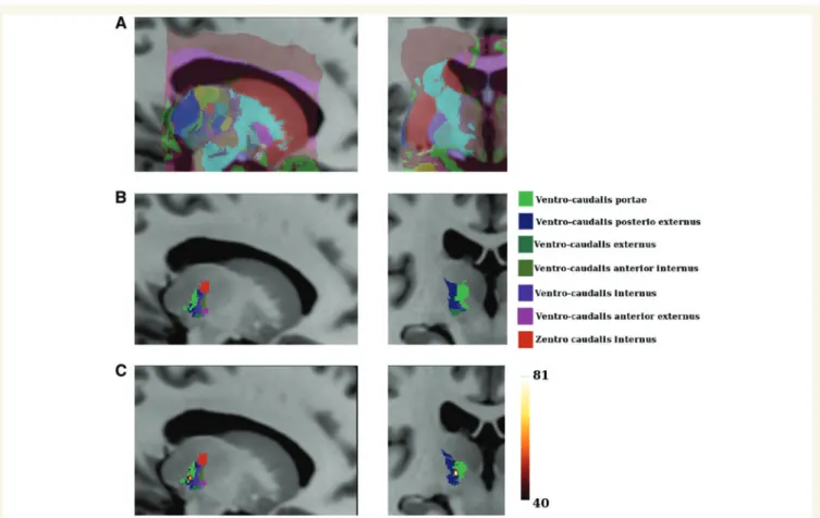 Figure 1 and Supplementary Tables 1 and 2 clearly indicate that the pattern of affected nuclei differs between patients with and without pain