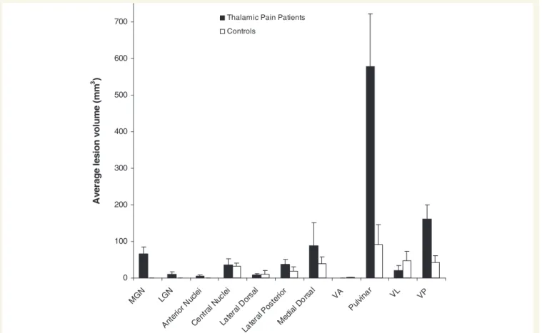 Figure 5 Mean group lesion volumes for specific thalamic nuclei in patients with central post-stroke pain of thalamic origin (black) and controls (white) in standard stereotaxic space