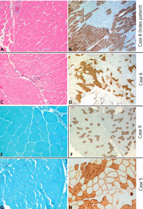 Fig. 1 Muscle histology ( A, B) The muscle autopsy of the index patient (case 8) demonstrates fibre-type grouping and numerous interna- interna-lized nuclei, while atrophic fibres were not frequently seen