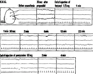 FIG. 12. Electroencephalogram trace from a male patient.