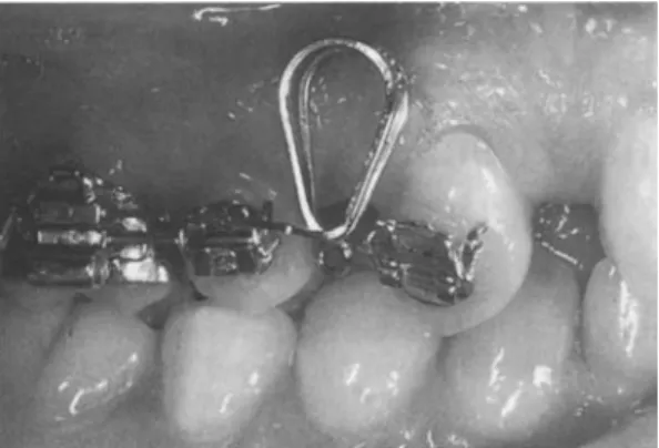 Figure 1 The Gjessing canine retraction spring as used in the present investigation.