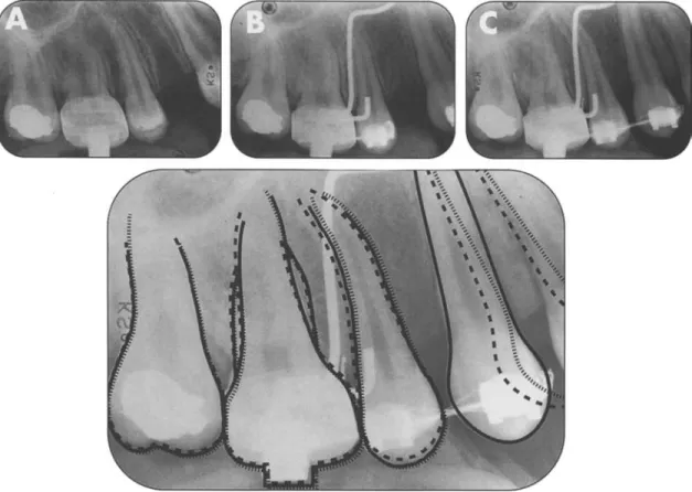 Figure 4 Radiographs of the healed side of one case at times Tl (A), T2 (B) and T3 (C)