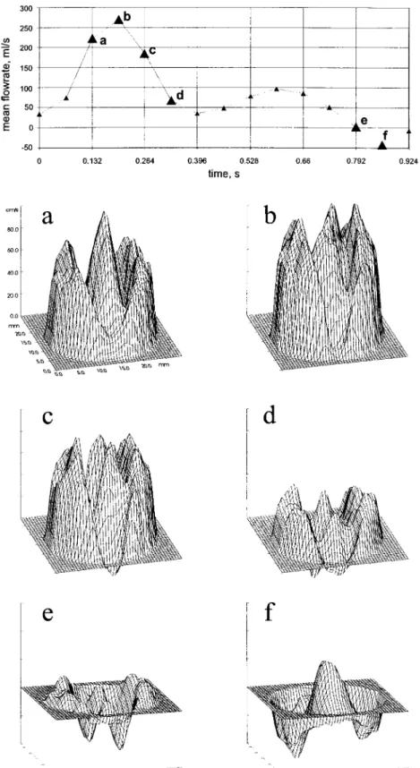 Fig. 2. Fluid velocity pro®les 0.25 mm downstream of a 25 mm aortic bilea¯et valve prosthesis mounted in the pulsatile ¯ow model shown in Fig