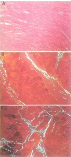 Figure 1 Photomicrographs (magnification X 300 and repro- repro-duced here at 80%) of different patterns of collagen accumulation and altered collagen architecture