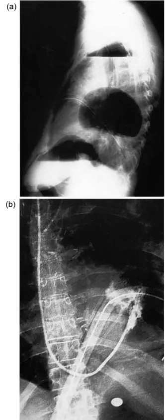 Fig. 3. Postoperative chest X-ray revealing diaphragmatic herniation following left sided pneumectomy and use of a diaphragmatic flap: (a) lateral view; and (b) p.-a