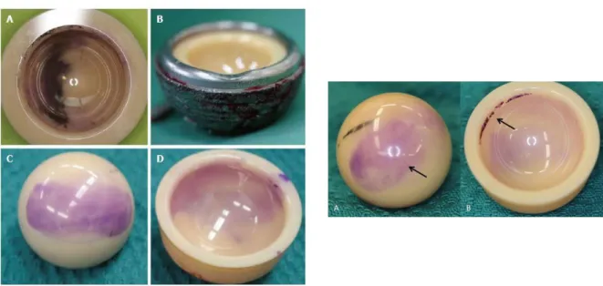 Fig. I.14 : Identification des bandes d'usure par un marquage violet sur la tête en céramique (A) et  doublure (B) ; l’impact est identifié par une encoche créée sur la coque acétabulaire (C et D) 