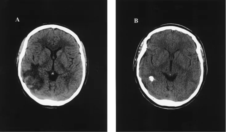 Figure 1. A, CT scan before empirical therapy for toxoplasmic encephalitis in an HIV-infected patient