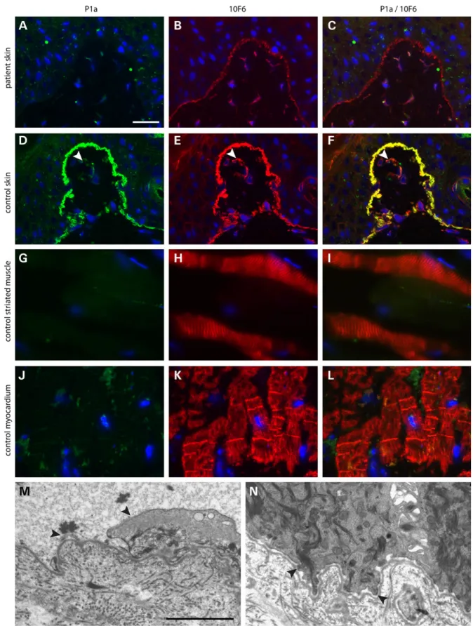 Figure 2. Double immuno ﬂ uorescence microscopy of human skin, muscle and heart tissue using antibodies to P1a (green) and an epitope shared between plectin isoforms (red) and transmission electron microscopy of skin