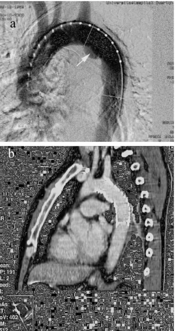 Fig. 2. (a) Intraoperative angiography of traumatic aortic rupture at level of aortic isthmus after blunt chest trauma
