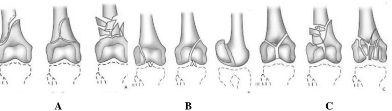 Figure I.4 Classification AO des fractures de l’extrémité inférieure du fémur [11] 
