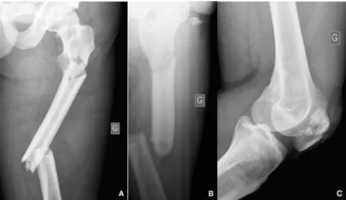 Figure I.8 Accident de moto. A, B. Fracture bifocale avec cylindre intermédiaire intact