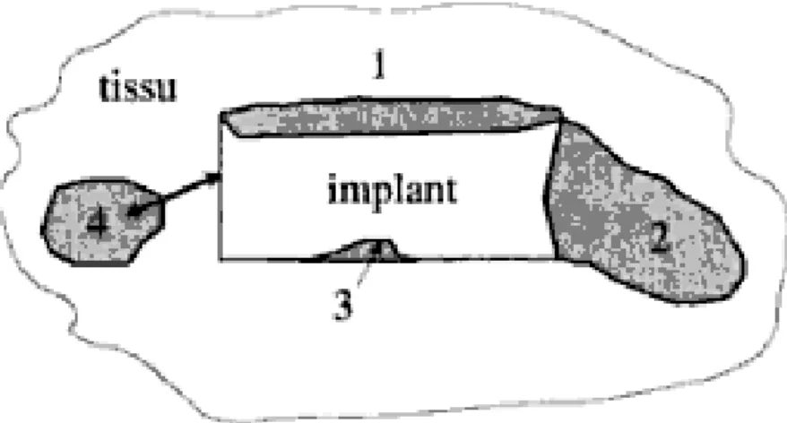 Figure II.3 Facteurs de biocompatibilité : 1=réactions à la surface ; 2=effet long  terme ; 3= modifications du matériau ; 4= dommages aux tissus [5]