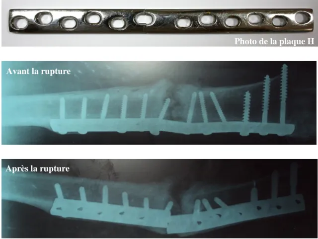 Figure III.1 Plaque fémorale H avec radiographie avant et après fracture   III.2.2 Plaque F en acier inoxydable 