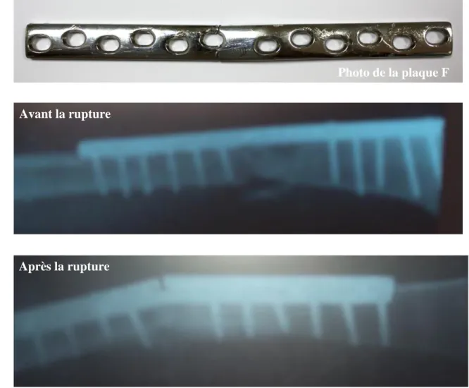 Figure III.2 Plaque fémorale F avec radiographie avant et après fracture   III.3 Caractérisation physico-chimique des plaques fémorales 
