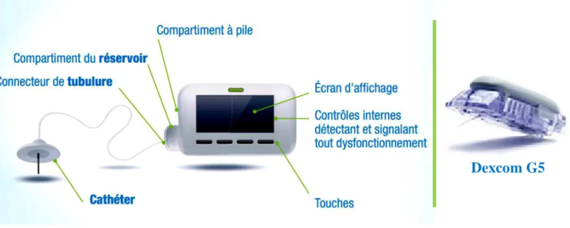 Figure 1. 7: La  pompe à insuline et le capteur continu de glucose Dexcom G5[44] 