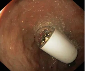 Figure III.1: Capsule endoscopique [123] 