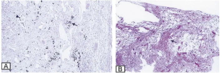Fig. 2. (A, B) Chest CT-scan showing bilateral peripheral bullous emphysema.