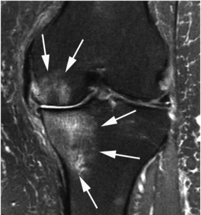 Figure  5.  IRM  d’un  genou  arthrosique.  Lésions  d’œdème  osseux  (flèche),  avec  hypersignal  en  T2,  métaphyso-épiphysaire médial