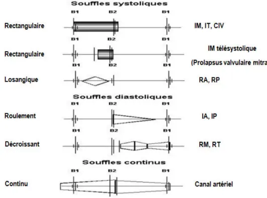 Fig. I.11.  Caractérisation schématique des différentes variétés des souffles que l’on peut rencontrer  pendant la révolution cardiaque (B1 et B2 correspondent à S1 et S2) 