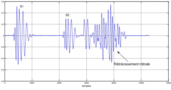 Fig. I.13.  Représentation d’un cycle cardiaque contenant une  insuffisance aortique 