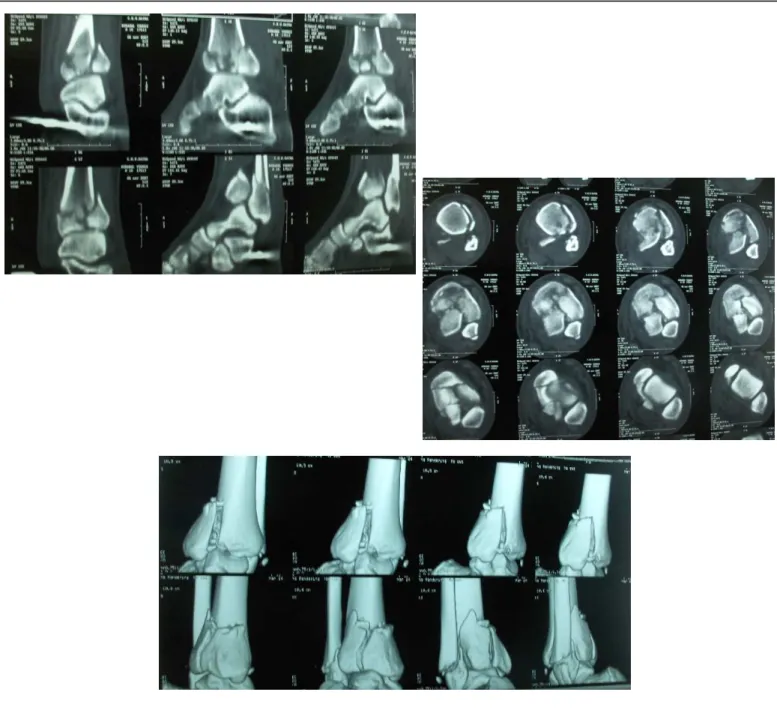 Fig. 34 : Coupes frontales, sagittales et reconstructions tridimensionnelles   d’une fracture du pilon tibial