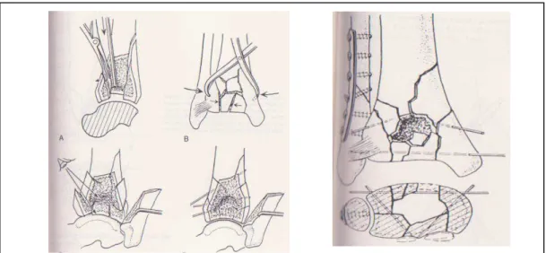 Fig 89 : Greffe osseuse et stablisation epiphyso-diaphysaire 