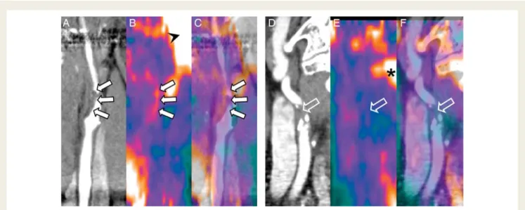 Figure 3 Qualitative characterization of coronary plaques as non-calcified (A), mixed (B), and calcified (C) by computed tomography angi- angi-ography