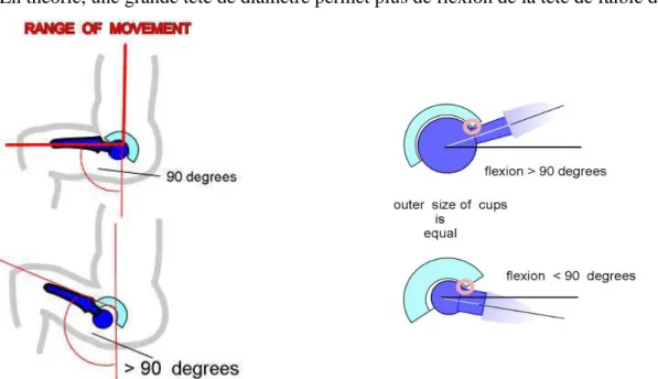 Figure 5 : La règle de 90 degrés, b) flexion suivant diamètres de têtes fémorales (Ch