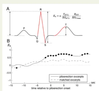 Figure 2 Effects of music on regional activity of the heart. (A) In addition to heart rate and heart rate variability, new approaches  in-vestigate effects of music on the regional activity of the heart as  re-flected in the amplitudes of ECG waves