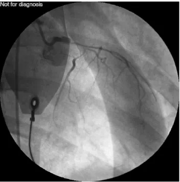 Fig. 2. A second view from the coronary angiography showing the dissection of the coronary arteries.