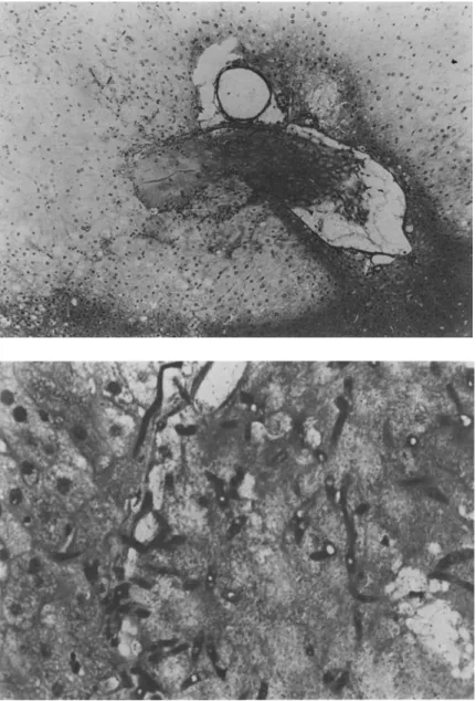 Figure 2. Hepatic lesion four days after iv challenge with a lethal dose of conidia. Top: an hepatic vein filled with thrombotic material and  neigh-bouring a large necrotic zone (clear area) with karyorrhexis and  karyoly-sis (x 400)