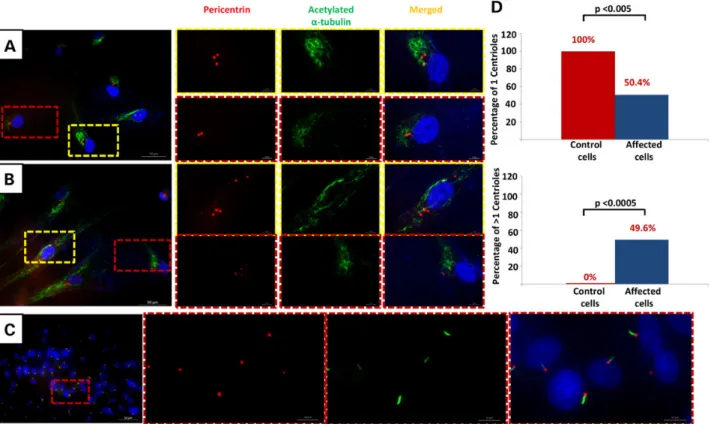 Figure 3. CEP120-related ciliopathy is associated with decreased cilium number and abnormal number of centrosomes