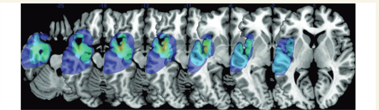 Figure 4 Lesion overlap in heautoscopy. Lesion overlap analysis highlighted the left posterior insula (centred on MNI coordinates x = 40, y = 1, z = 10), which was found to be involved in five out of nine patients with heautoscopy