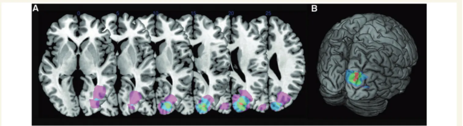 Figure 6 Voxel-based lesion symptom mapping in heauto- heauto-scopy. Lesion overlap contrast yielded maximal involvement of the left posterior insula (centred on MNI coordinates x = 40, y = 2, z = 11; Z-score = 3.31, P 5 0.01, corrected for FDR) for heauto