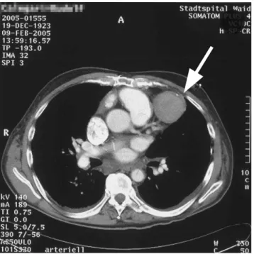 Fig. 1. Thoracic CT scan showing a para-median left 9 cm oval, encapsulated and slightly calcified formation, adjacent to the left ventricle and pulmonary trunk.