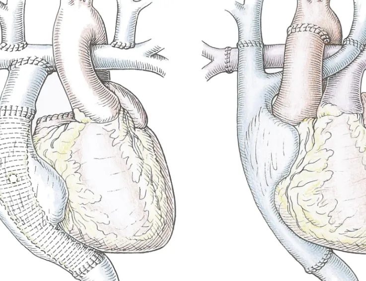 Fig. 1. The artist’s drawing demonstrates the pre-transplant operative situs with the total cavo-pulmonary connection including a bilateral, bidirectional Glenn shunt and the intra-atrial Gore-Tex tube graft to connect the inferior vena cava to the pulmona
