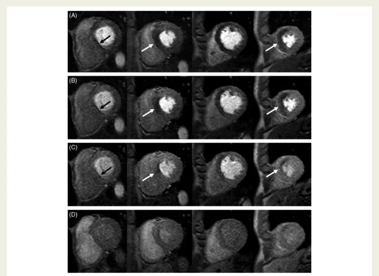 Figure 4 Case example: myocardial perfusion-cardiac magnetic resonance study of a 56-year-old patient with 90% stenosis of the left anterior descending coronary artery on subsequent coronary angiography