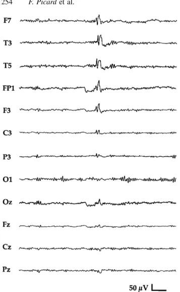 Fig. 2 Isolated spike-and-waves predominant in the temporal Neuropsychology and psychiatry