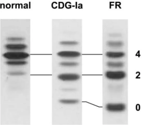 Figure 1. Isoelectric focusing of serum transferrin. Samples from a healthy control serum (normal), from a CDG-Ia control and from patient FR are shown.
