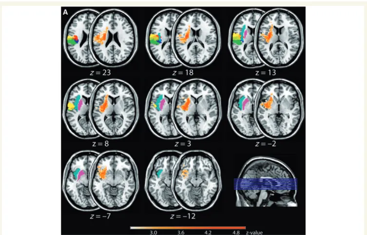 Figure 1 Results of the non-parametric Liebermeister test for the group of left and right brain-lesioned patients