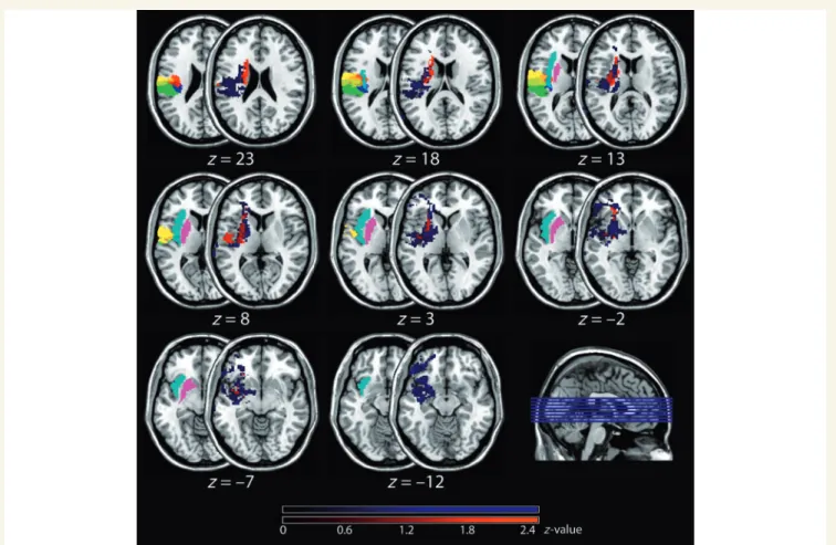 Figure 2 Mean z-scores. Shown are the mean z-scores of left brain-lesioned patients in whom the entire right body site was affected (n = 7, coloured in blue) and in whom only the upper limb was affected (n = 4; coloured in red)