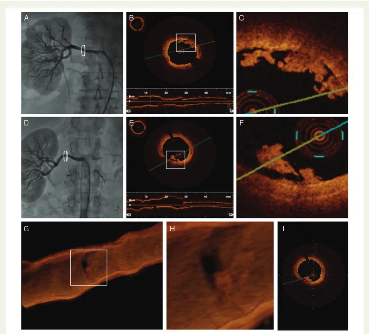 Figure 5 Thrombus formation after renal nerve ablation. Significant intraluminal thrombus formation after renal nerve denervation are inapparent in angiography (A and D), however displayed in different OCT cross-sections (B, C, E, F and I) and in three-dim