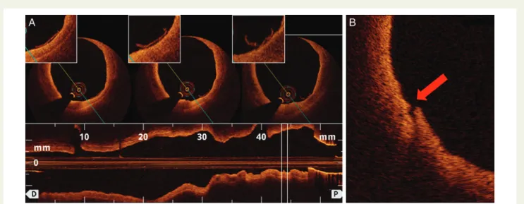 Figure 6 Dissections after renal nerve ablation. Endothelial detachments (A, white box) and vessel wall dissections (B, red arrow) detected in treated renal arteries with the EnligHTN TM catheter.