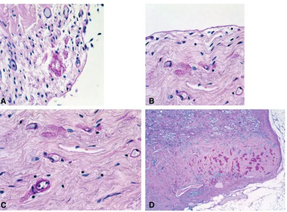 Fig. 2. Complete papillary necrosis in patient 1, Table 5. (A–C) Ureter with remnants of capillary sclerosis; (D) papillary necrosis with massive Tamm–Horsfall protein deposits (strong PAS-positive material).