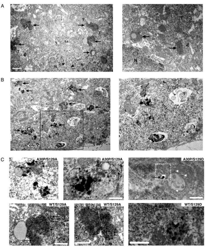 Figure 3. IEM demonstrating a-syn-positive aggregates and extensive nigral human a-syn-positive staining