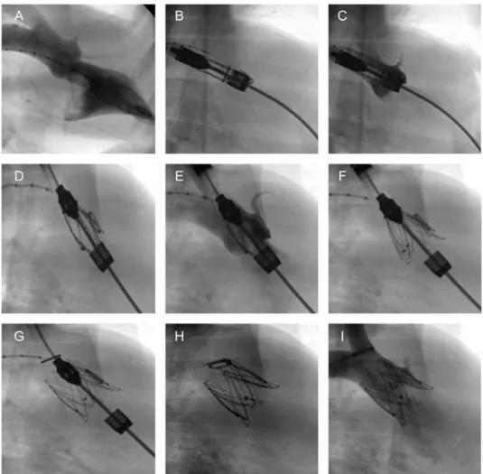 Figure 3: Fluoroscopy-guided, anatomically oriented transapical delivery of marrow stromal cell-based TEHVs into the aortic valve position